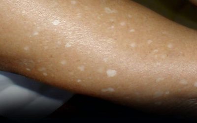 Hai notato delle piccole macchie bianche sulle braccia o sulle gambe? Ecco cosa sono