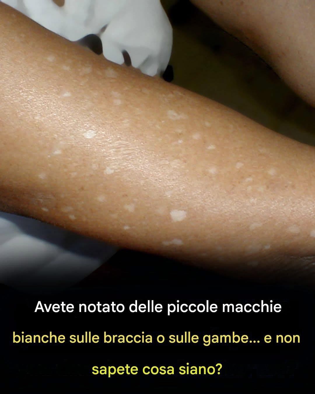Hai notato delle piccole macchie bianche sulle braccia o sulle gambe? Ecco cosa sono