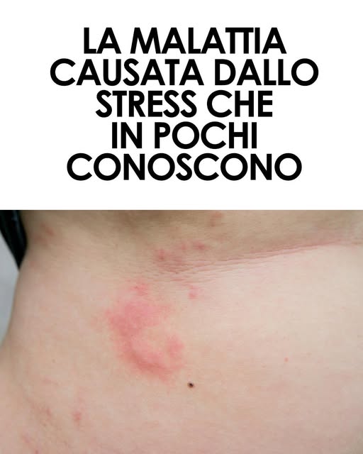 Un calo improvviso del sistema immunitario, probabilmente causato da un forte stress fisico o emotivo, potrebbe facilitare la riattivazione del virus