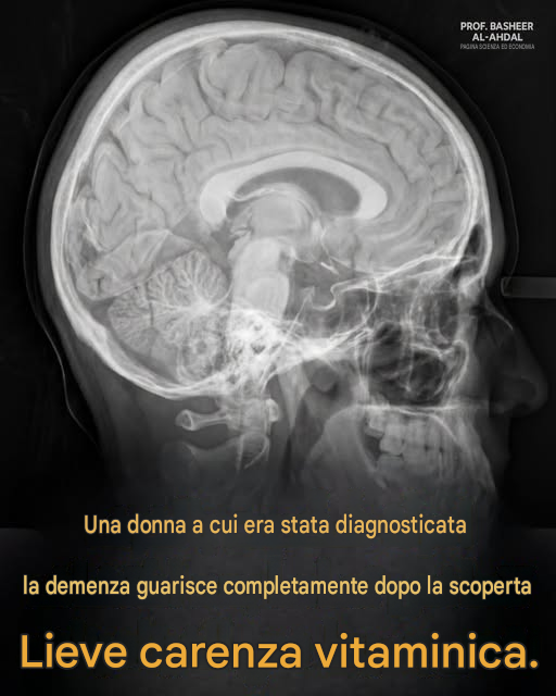 📢 Demenza o carenza vitaminica? Una storia che ti ricorda di non arrenderti mai  🤔 I medici pensavano avesse la demenza: cosa hanno scoperto?