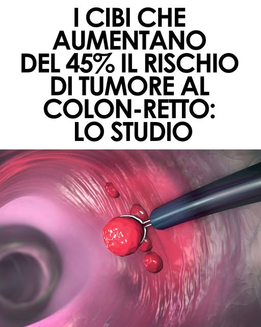 Tumore al colon-retto, lo studio di Harvard: questi cibi possono aumentare il rischio fino al 45% ⬇️