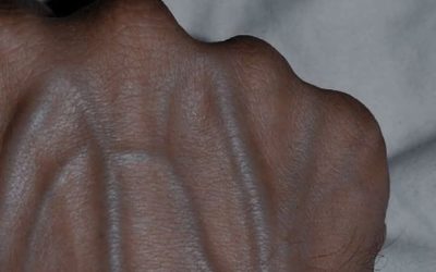 5 condizioni di salute che possono causare vene visibili