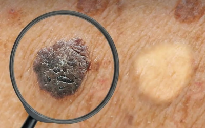 Come eliminare verruche e fibromi penduli durante la notte?