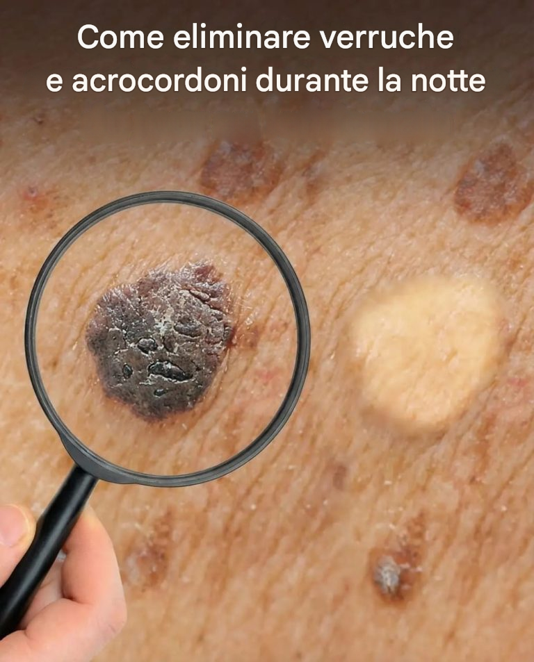 Come eliminare verruche e fibromi penduli durante la notte?
