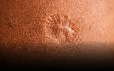 La cicatrice lasciata dal vaccino contro il vaiolo rimane un segno iconico ancora visibile in molte persone vaccinate. Essa testimonia sia una svolta fondamentale nella storia della medicina, sia il naturale processo di guarigione della pelle. Comprenderne la formazione ci permette di cogliere meglio la risposta dell’organismo a questo vaccino antico ma cruciale per l’eradicazione della malattia.