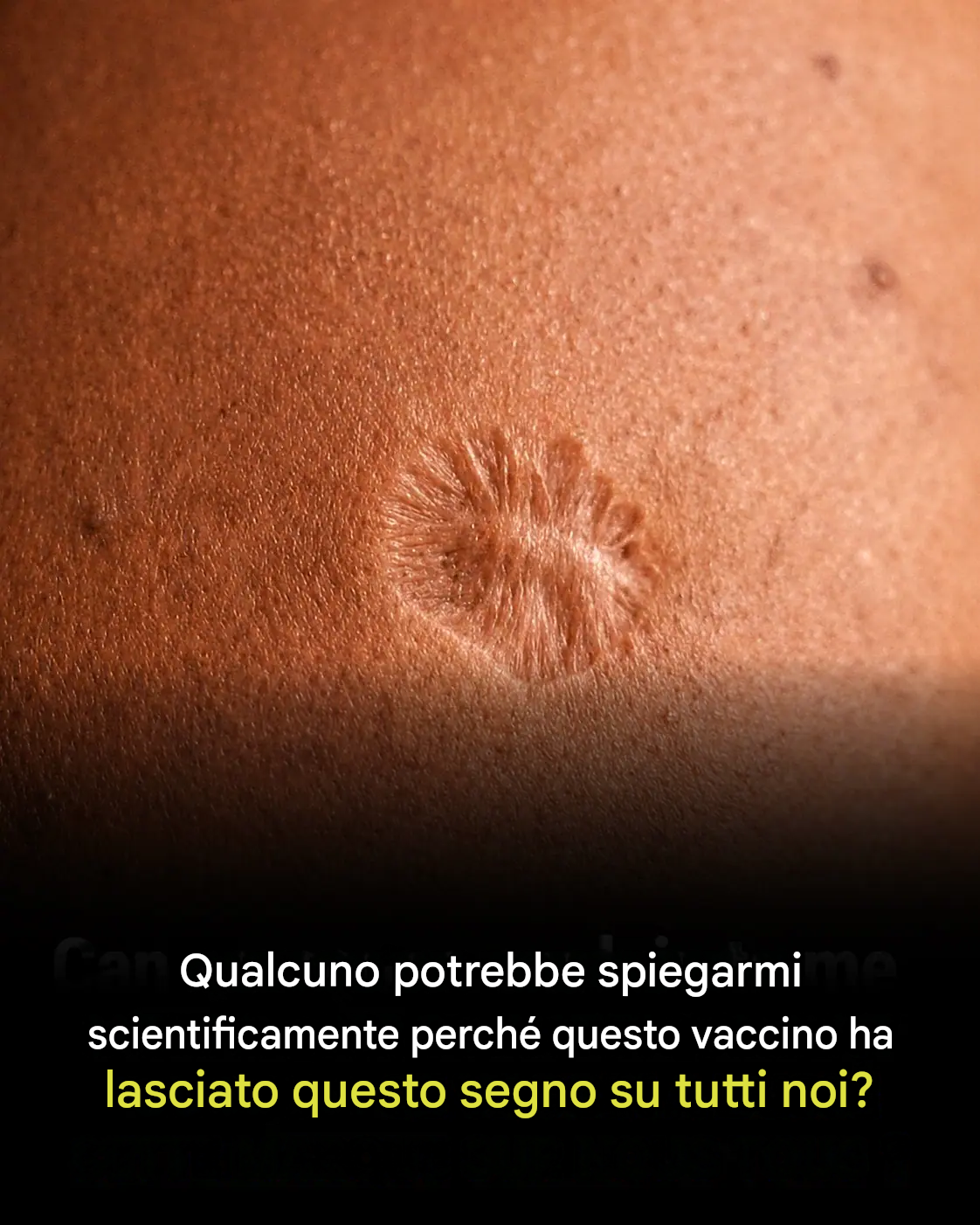 La cicatrice lasciata dal vaccino contro il vaiolo rimane un segno iconico ancora visibile in molte persone vaccinate. Essa testimonia sia una svolta fondamentale nella storia della medicina, sia il naturale processo di guarigione della pelle. Comprenderne la formazione ci permette di cogliere meglio la risposta dell’organismo a questo vaccino antico ma cruciale per l’eradicazione della malattia.