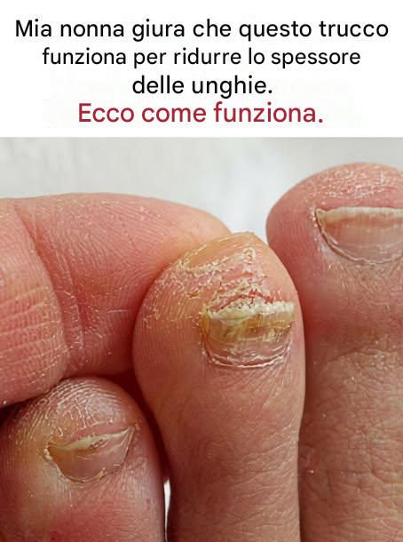 Dite addio alle unghie ispessite… Trovate la soluzione nel primo commento.👇