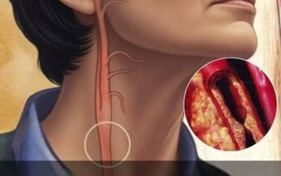 10 indicatori di arterie ostruite da non ignorare