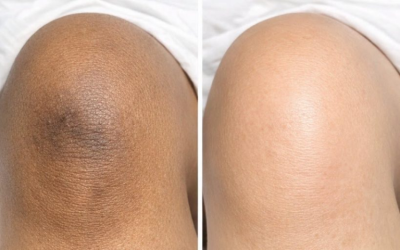 Con questo trucco unico per le ginocchia, ti libererai di rotule scure e ruvide, scolorimento ostinato e macchie secche e squamose.