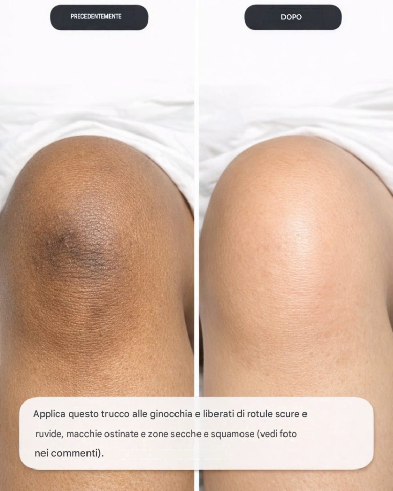 Con questo trucco unico per le ginocchia, ti libererai di rotule scure e ruvide, scolorimento ostinato e macchie secche e squamose.