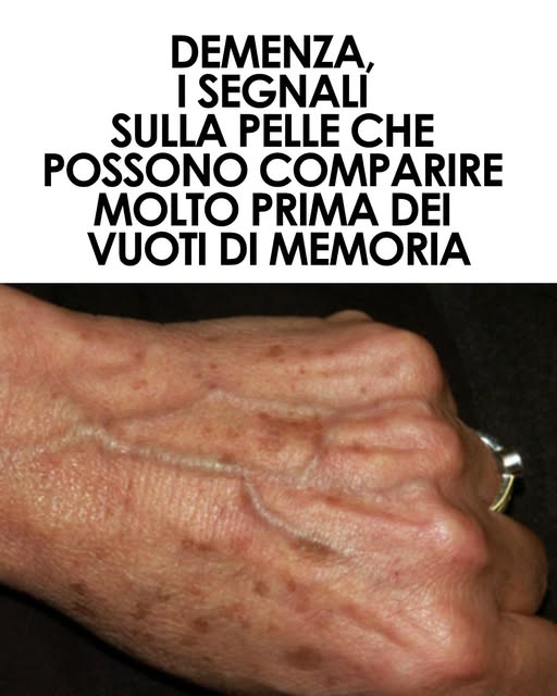 Demenza, la pelle può dare segnali molto prima dei vuoti di memoria. Ecco a cosa devi fare attenzione ⬇️