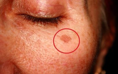 Cosa significa avere queste macchie sul viso e come eliminarle (1 / 2)