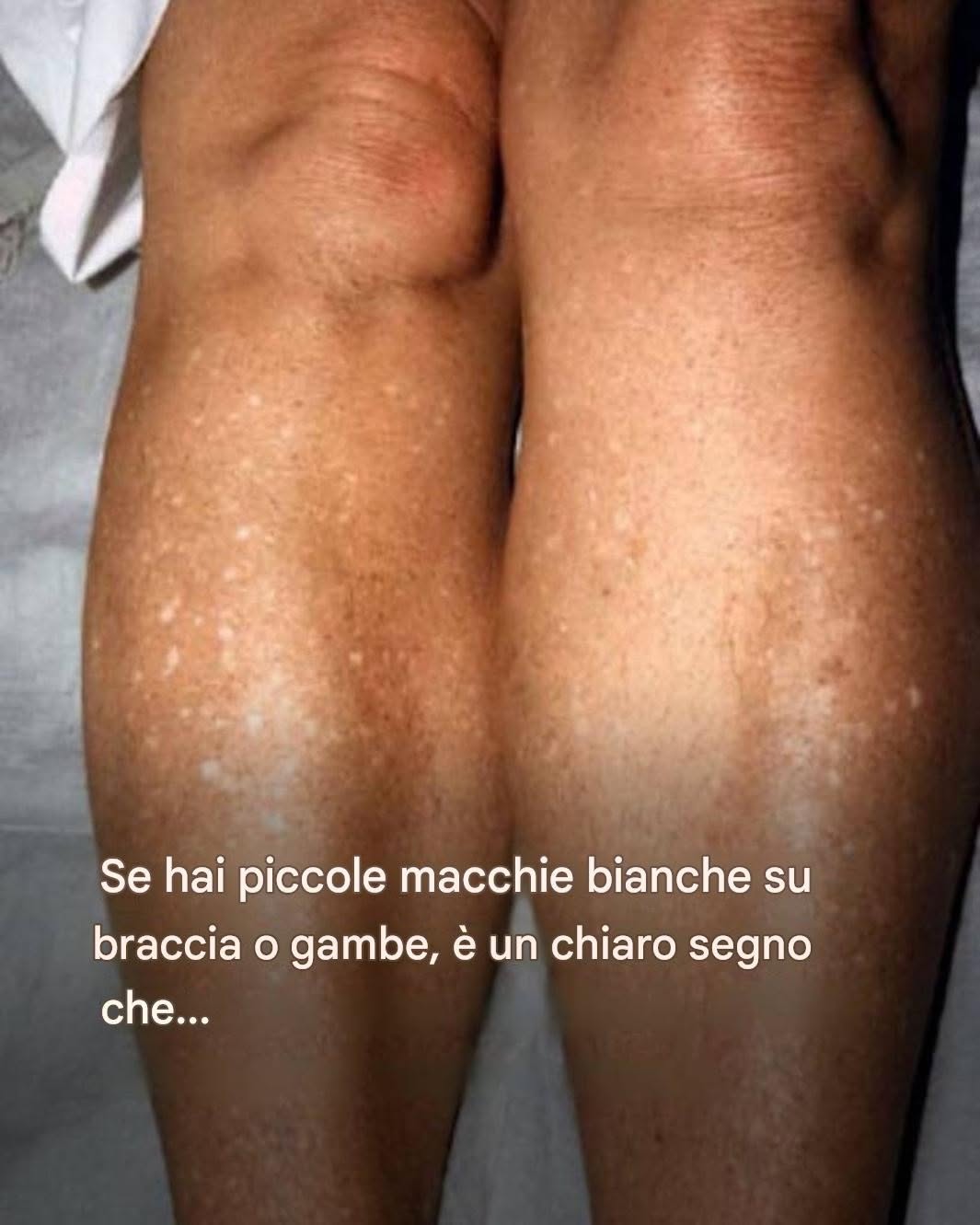Perché mi compaiono macchie bianche sulla pelle d’estate e come posso trattarle? Risponde un dermatologo.
