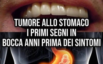 Neoplasia allo Stomaco, i primi segni in bocca anni prima dei sintomi (1 / 2)