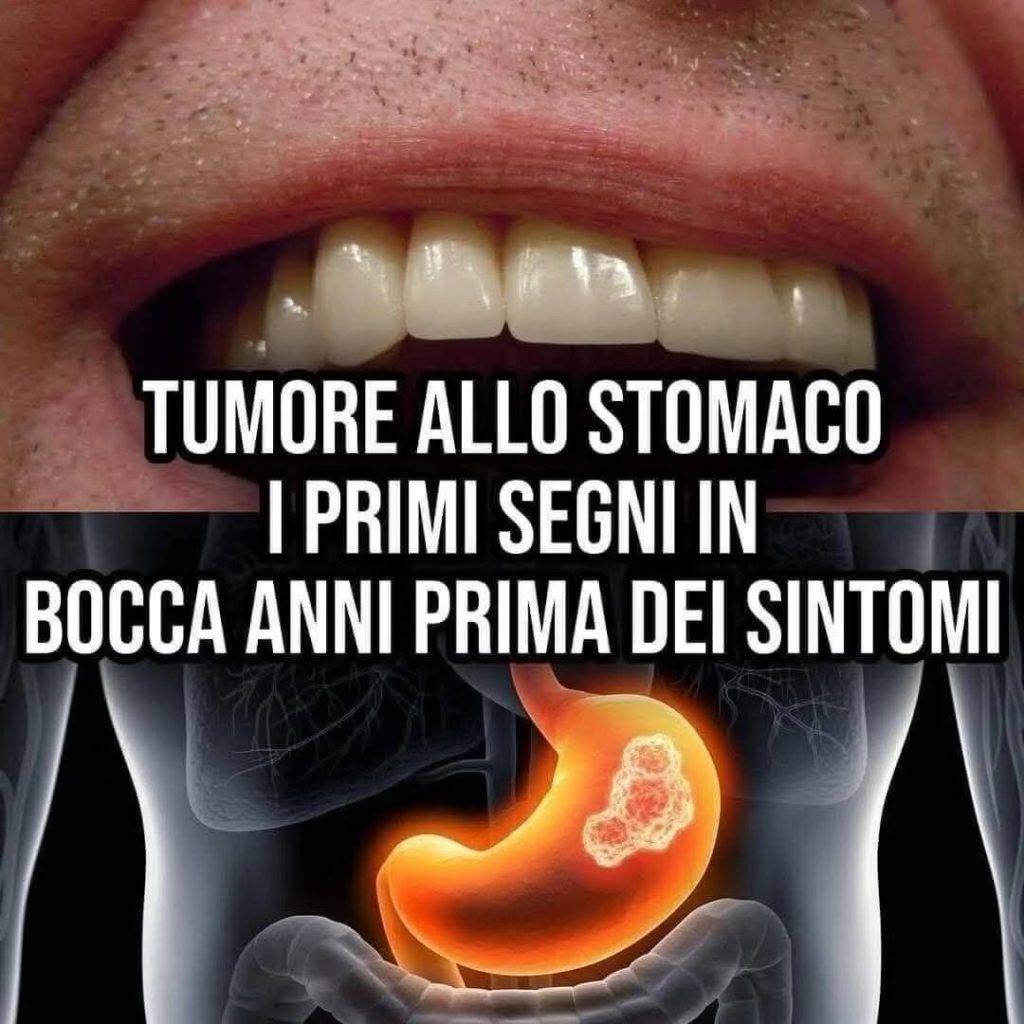 Neoplasia allo Stomaco, i primi segni in bocca anni prima dei sintomi (1 / 2)
