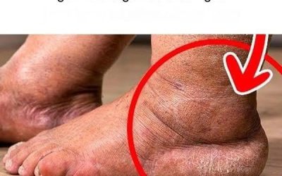 La migliore vitamina per eliminare il gonfiore a gambe e caviglie