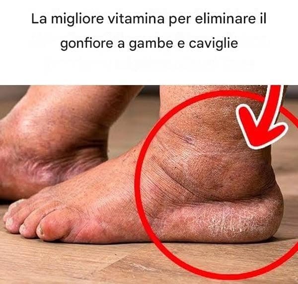 La migliore vitamina per eliminare il gonfiore a gambe e caviglie